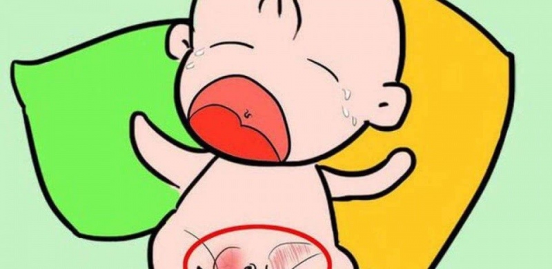 疝气嵌顿导致睾丸切除的份额高达20%刚满一岁的航航是一个爱哭的宝宝